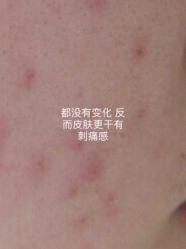 体验前-佰草博士·专业祛痘祛斑培训