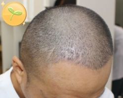 -大麦微针植发丨全国连锁