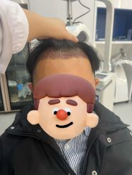 体验后-大麦微针植发全国连锁