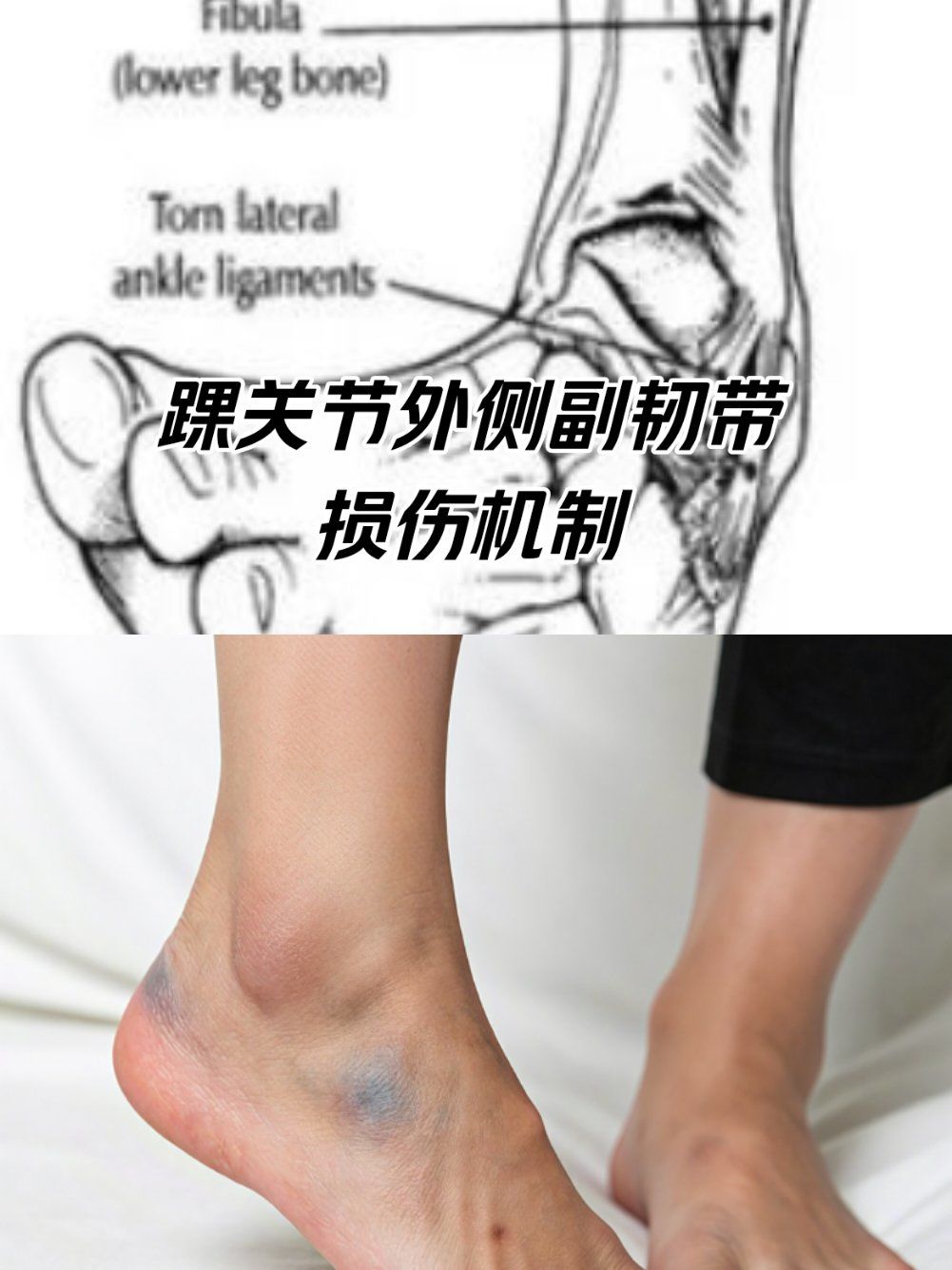 踝关节外侧副韧带损伤机制