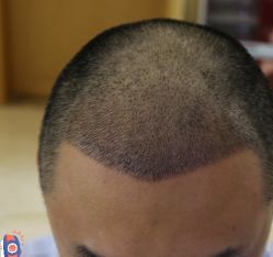 -大麦微针植发丨全国连锁