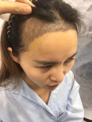 -大麦微针植发丨全国连锁