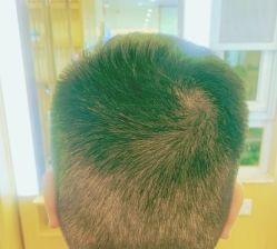 -大麦微针植发丨全国连锁