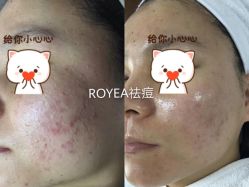 -ROYEA茹彦祛痘·问题肌肤修护中心