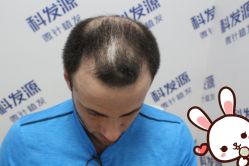 -大麦微针植发丨全国连锁