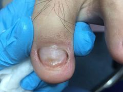 -Andrew指甲专科灰指甲·甲沟炎矫正·3D步态矫形鞋垫定制(浦三路店)