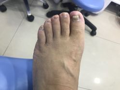 点击看大图 -德哥灰指甲脚气甲沟炎跖疣护理