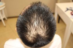 点击看大图 -大麦微针植发丨全国连锁