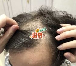 -大麦微针植发全国连锁