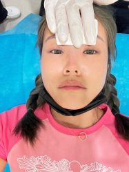 体验后-海涛医疗美容·面部抗衰·注射美鼻