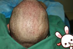 点击看大图 -大麦微针植发丨全国连锁