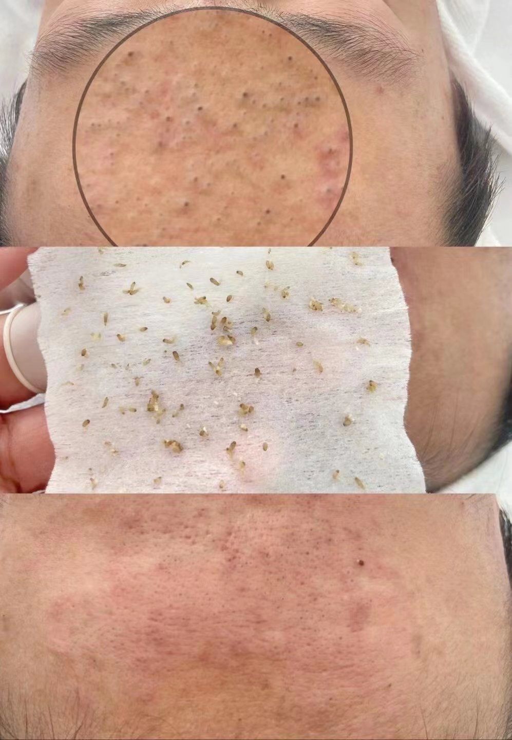 当我发现毛孔堵塞时,我开始意识到单纯的补水并不能解决问题