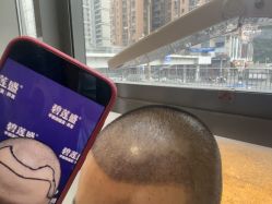 -碧莲盛·不剃发植发