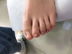 -德哥灰指甲脚气甲沟炎跖疣护理