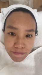 体验后-美肤盾祛痘·问题肌头疗管理中心