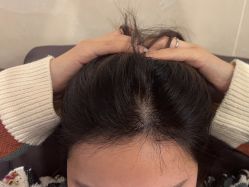 -碧莲盛·不剃发植发