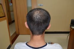 -大麦微针植发丨全国连锁