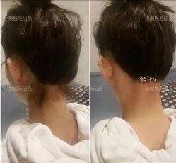-小梨·OndaPro·专业脱毛连锁机构