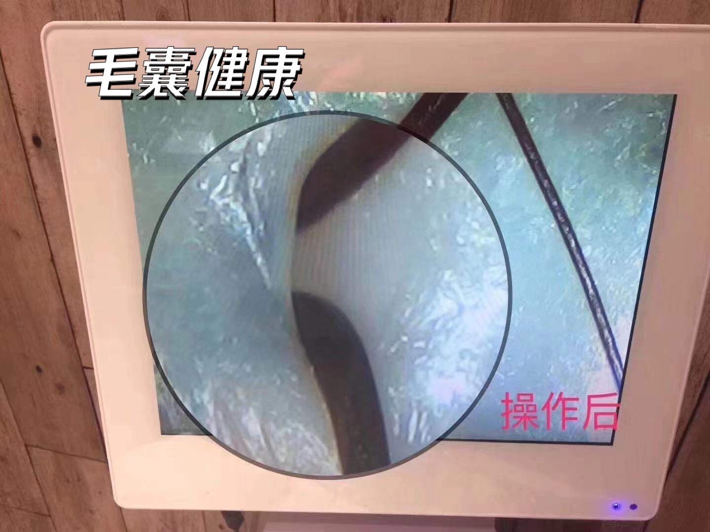 健康毛囊是什么样?