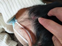 -北京美痣堂古方祛痣斑疣瘊