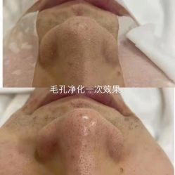 点击看大图 -凡碧诗毛孔清洁收细