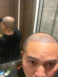 -碧莲盛·不剃发植发