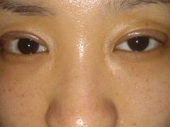 第二天，是最肿的-上海华安整形外科门诊部