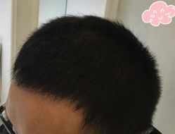 -大麦微针植发丨全国连锁