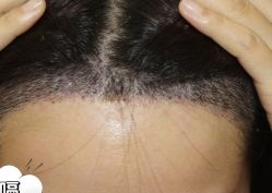 -大麦微针植发丨全国连锁