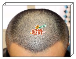 -大麦微针植发全国连锁