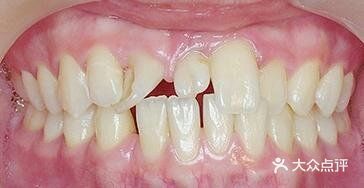 监控孩子多生牙，一发现就把它拔了！