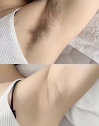 -薇兰专业脱毛连锁机构