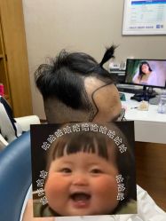 -大麦微针植发全国连锁