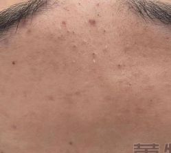 -蕾特恩专业祛痘·皮肤管理