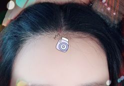 -大麦微针植发全国连锁