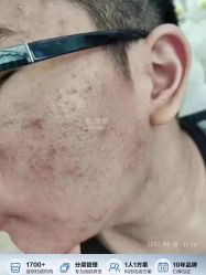 -蕾特恩专业祛痘国际连锁