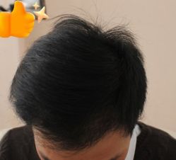 -大麦微针植发丨全国连锁