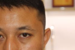 -大麦微针植发丨全国连锁