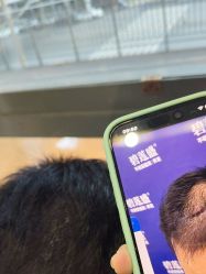 -碧莲盛·不剃发植发