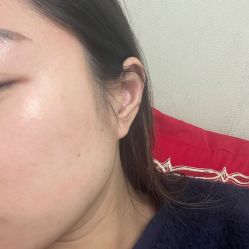 体验后-agge蛋白医美