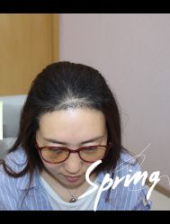 点击看大图 -大麦微针植发全国连锁