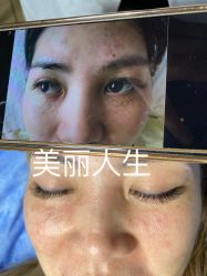 -爱莎扁平疣·汗管瘤·斑痣中心