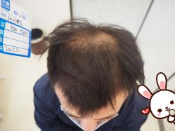 -大麦微针植发丨全国连锁