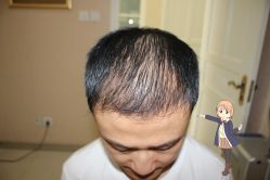 -大麦微针植发丨全国连锁