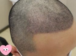 -大麦微针植发丨全国连锁