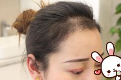 -大麦微针植发丨全国连锁