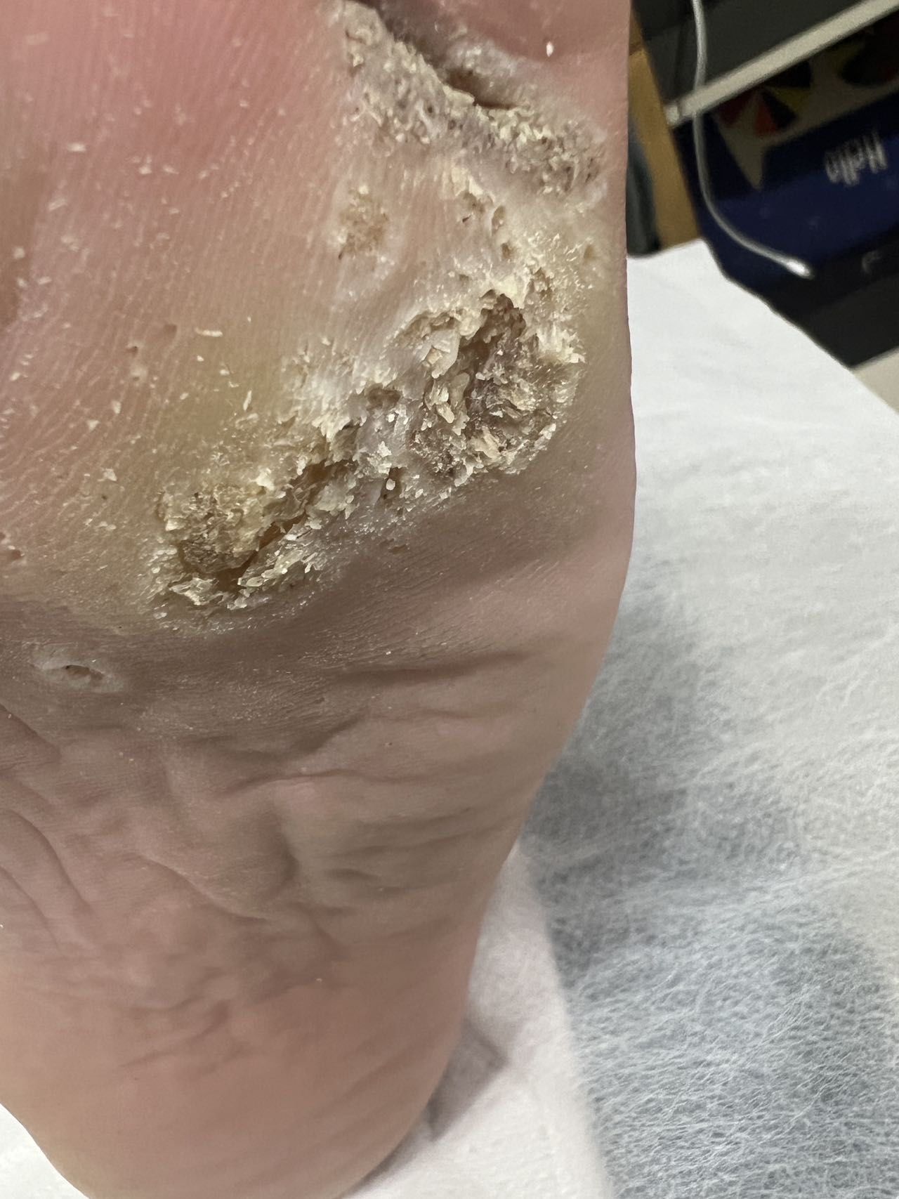 脚指甲往肉里长怎么办 足部护理