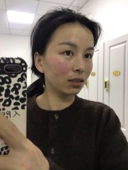 体验后-东剑医学美容·注射美学中心