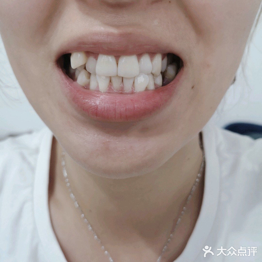 牙套日记|时代天使隐形矫正双模冠军