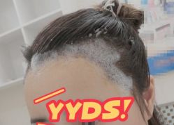 -大麦微针植发丨全国连锁